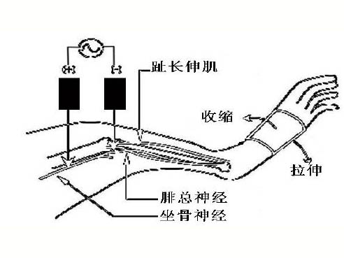 肌肉延遲性酸痛的機制研究進展